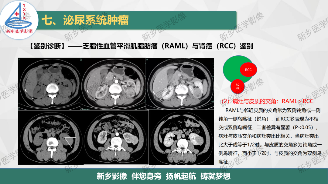影像PPT - 【PPT】肾脏肿瘤分期 并与肾脏血管平滑肌脂肪瘤鉴别要点-24