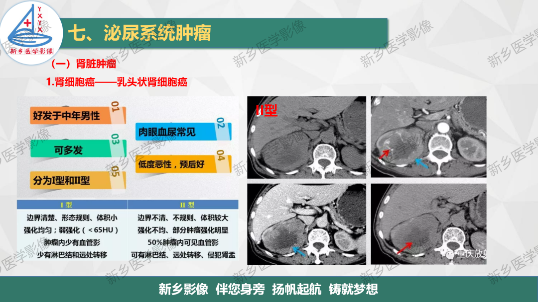 影像PPT - 【PPT】肾脏肿瘤分期 并与肾脏血管平滑肌脂肪瘤鉴别要点-12