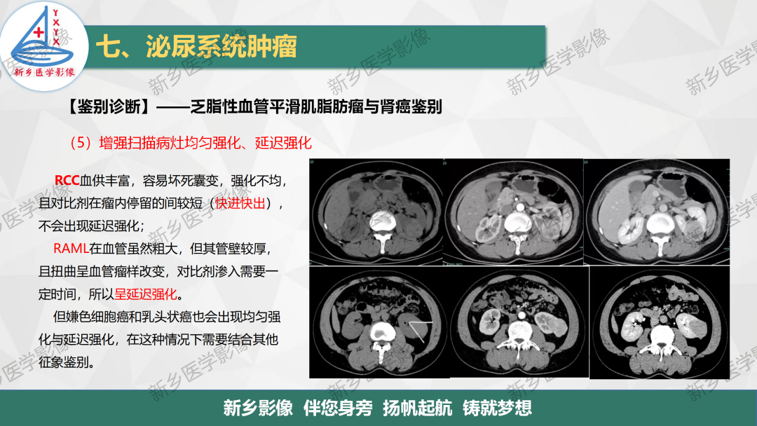 影像PPT - 【PPT】肾脏肿瘤分期 并与肾脏血管平滑肌脂肪瘤鉴别要点-27