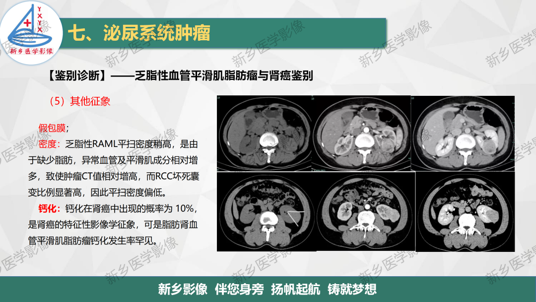影像PPT - 【PPT】肾脏肿瘤分期 并与肾脏血管平滑肌脂肪瘤鉴别要点-28