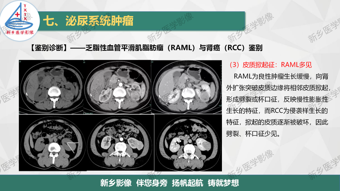 影像PPT - 【PPT】肾脏肿瘤分期 并与肾脏血管平滑肌脂肪瘤鉴别要点-25