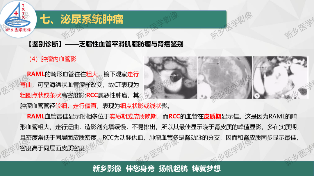影像PPT - 【PPT】肾脏肿瘤分期 并与肾脏血管平滑肌脂肪瘤鉴别要点-26