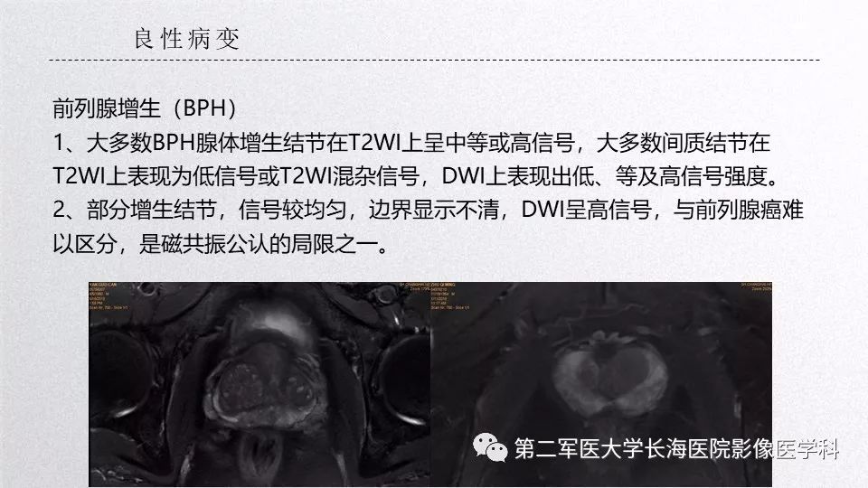 影像PPT - 【PPT】前列腺影像、报告及数据系统临床应用-16 影像PPT - 【PPT】前列腺影像、报告及数据系统临床应用-16