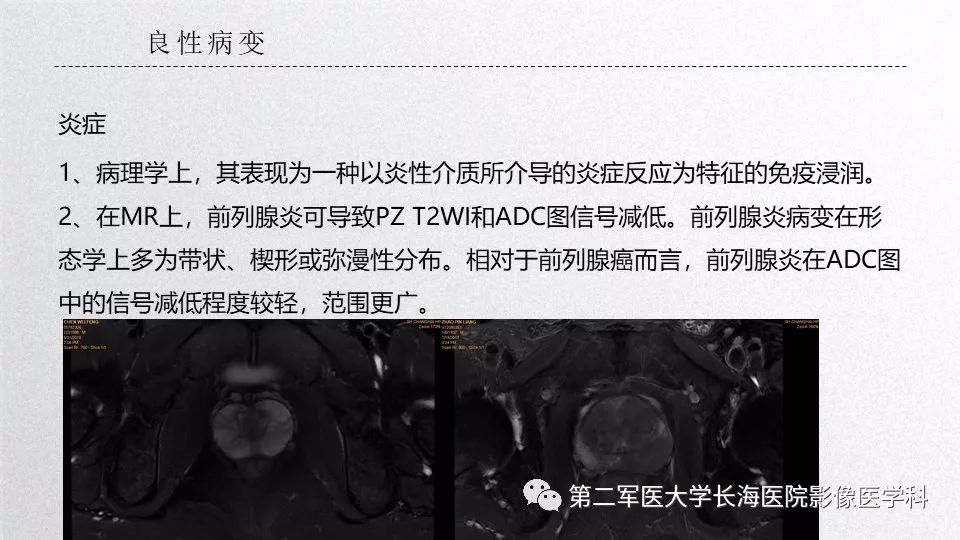 影像PPT - 【PPT】前列腺影像、报告及数据系统临床应用-17 影像PPT - 【PPT】前列腺影像、报告及数据系统临床应用-17