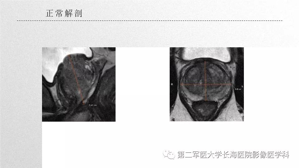 影像PPT - 【PPT】前列腺影像、报告及数据系统临床应用-15 影像PPT - 【PPT】前列腺影像、报告及数据系统临床应用-15