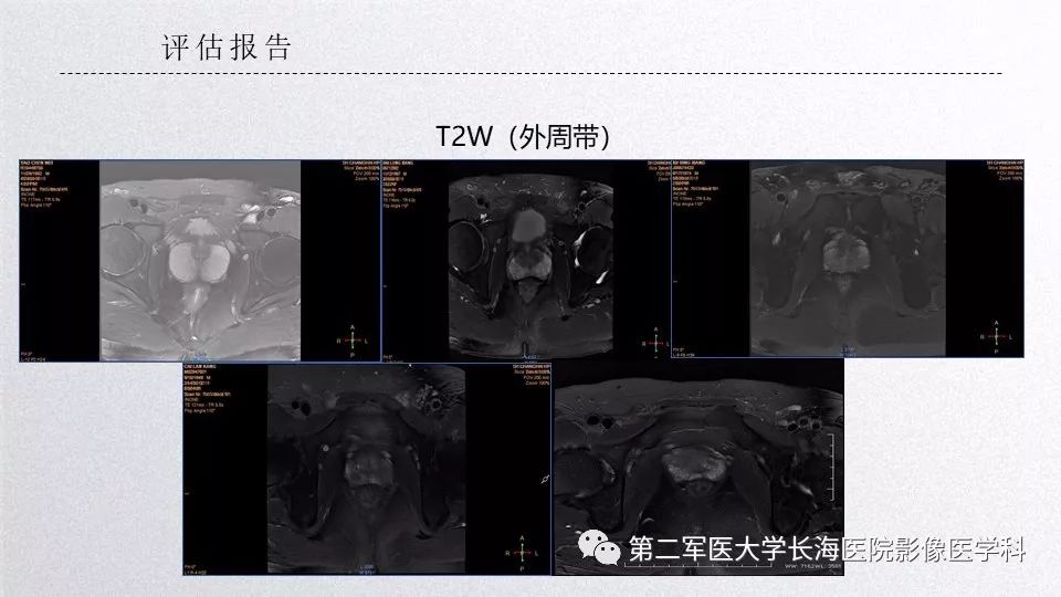 影像PPT - 【PPT】前列腺影像、报告及数据系统临床应用-22 影像PPT - 【PPT】前列腺影像、报告及数据系统临床应用-22