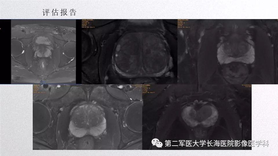 影像PPT - 【PPT】前列腺影像、报告及数据系统临床应用-24 影像PPT - 【PPT】前列腺影像、报告及数据系统临床应用-24