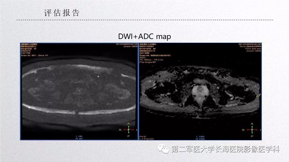 影像PPT - 【PPT】前列腺影像、报告及数据系统临床应用-26 影像PPT - 【PPT】前列腺影像、报告及数据系统临床应用-26