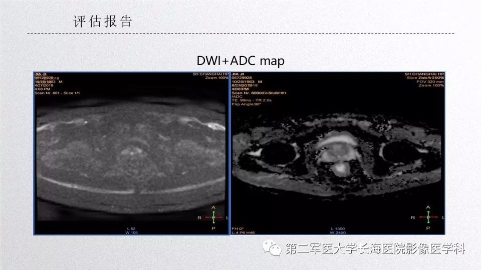 影像PPT - 【PPT】前列腺影像、报告及数据系统临床应用-27 影像PPT - 【PPT】前列腺影像、报告及数据系统临床应用-27