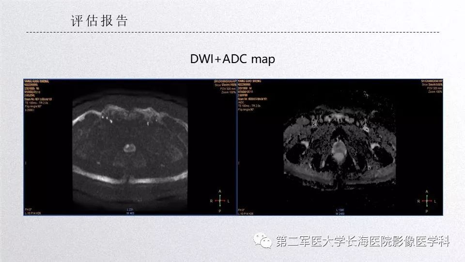 影像PPT - 【PPT】前列腺影像、报告及数据系统临床应用-29 影像PPT - 【PPT】前列腺影像、报告及数据系统临床应用-29