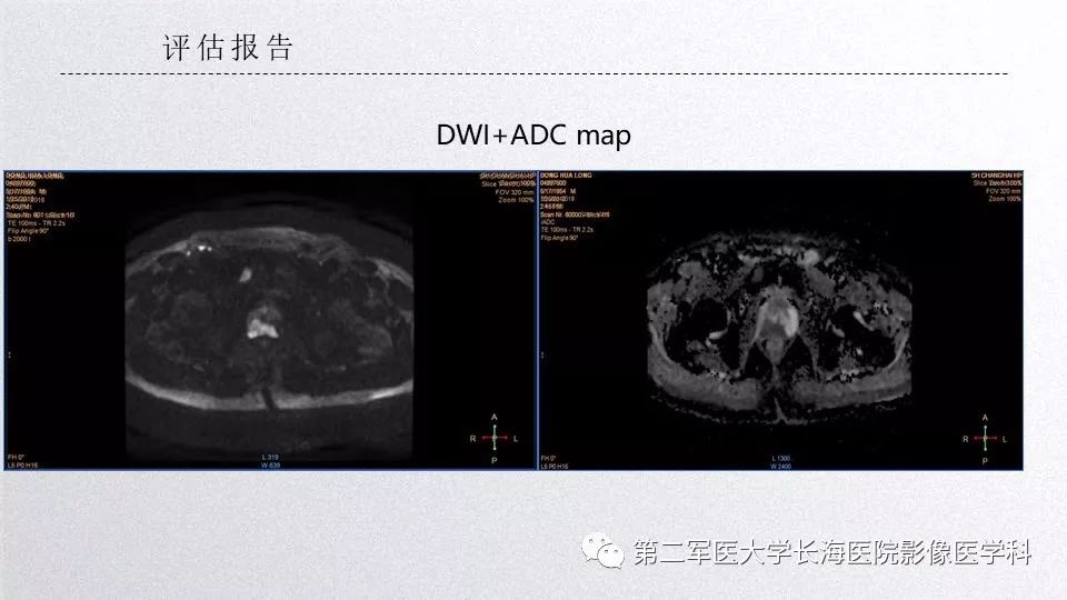 影像PPT - 【PPT】前列腺影像、报告及数据系统临床应用-30 影像PPT - 【PPT】前列腺影像、报告及数据系统临床应用-30