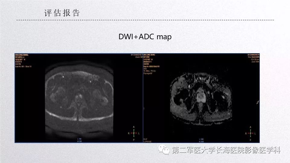 影像PPT - 【PPT】前列腺影像、报告及数据系统临床应用-28 影像PPT - 【PPT】前列腺影像、报告及数据系统临床应用-28
