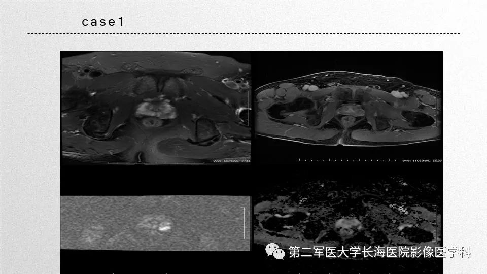 影像PPT - 【PPT】前列腺影像、报告及数据系统临床应用-37 影像PPT - 【PPT】前列腺影像、报告及数据系统临床应用-37