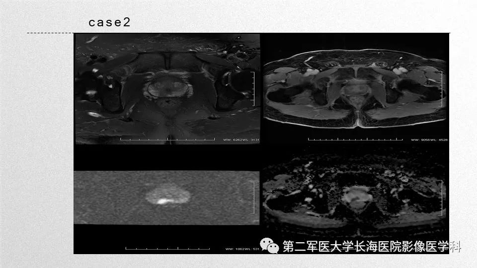 影像PPT - 【PPT】前列腺影像、报告及数据系统临床应用-38 影像PPT - 【PPT】前列腺影像、报告及数据系统临床应用-38