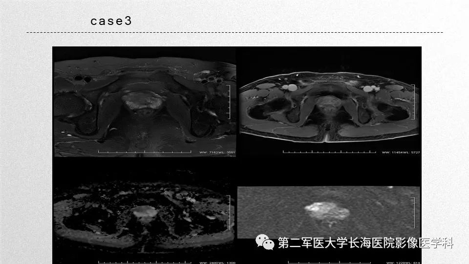 影像PPT - 【PPT】前列腺影像、报告及数据系统临床应用-39 影像PPT - 【PPT】前列腺影像、报告及数据系统临床应用-39