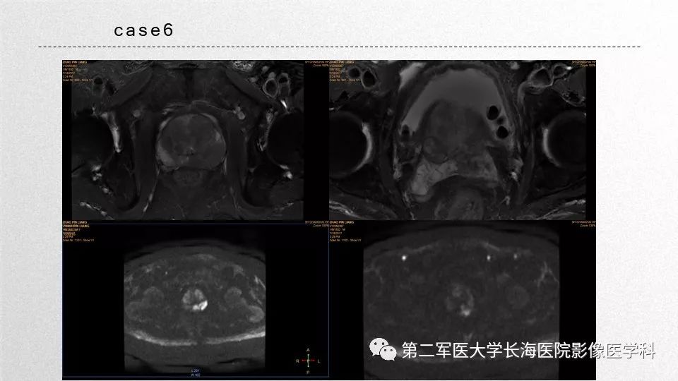 影像PPT - 【PPT】前列腺影像、报告及数据系统临床应用-42 影像PPT - 【PPT】前列腺影像、报告及数据系统临床应用-42