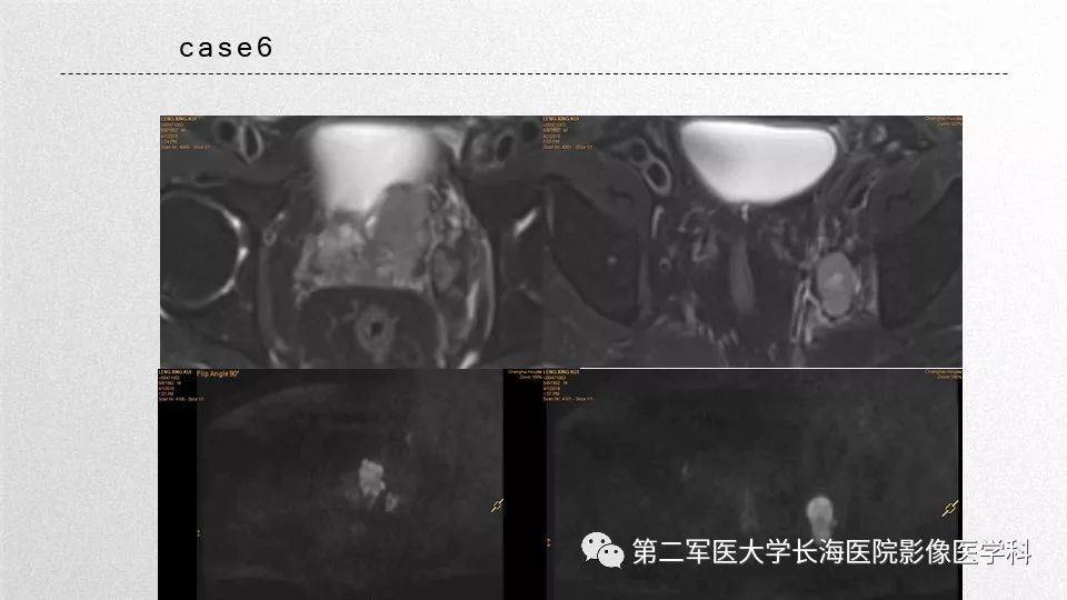 影像PPT - 【PPT】前列腺影像、报告及数据系统临床应用-43 影像PPT - 【PPT】前列腺影像、报告及数据系统临床应用-43