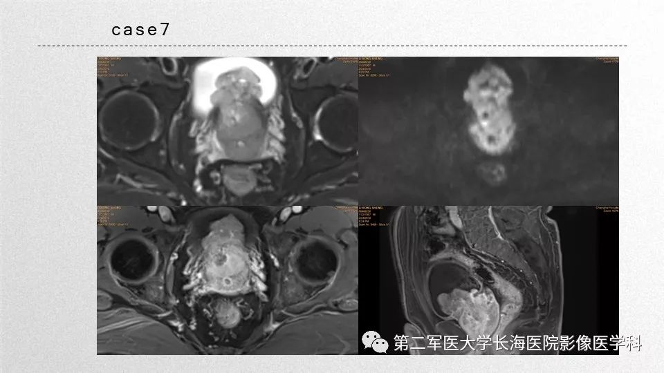 影像PPT - 【PPT】前列腺影像、报告及数据系统临床应用-44 影像PPT - 【PPT】前列腺影像、报告及数据系统临床应用-44
