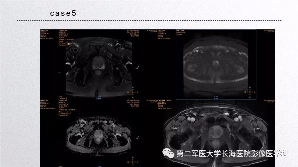影像PPT - 【PPT】前列腺影像、报告及数据系统临床应用-41 影像PPT - 【PPT】前列腺影像、报告及数据系统临床应用-41