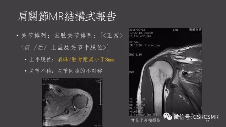 影像PPT - 【PPT】肩关节MRI的结构式评估-17