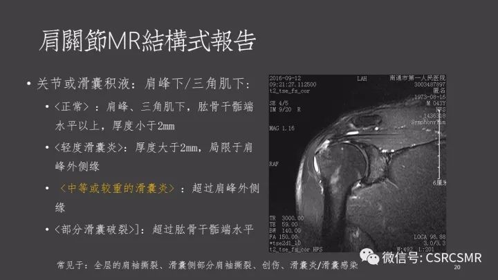 影像PPT - 【PPT】肩关节MRI的结构式评估-20