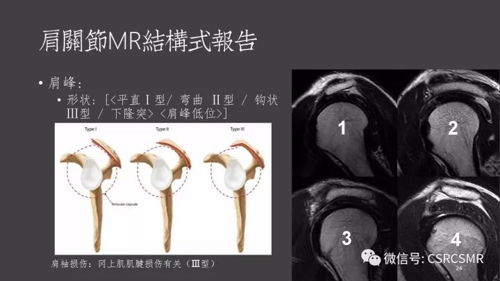 影像PPT - 【PPT】肩关节MRI的结构式评估-24