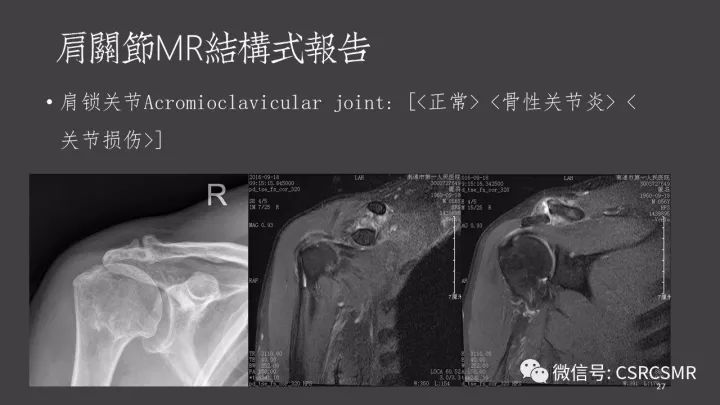 影像PPT - 【PPT】肩关节MRI的结构式评估-27