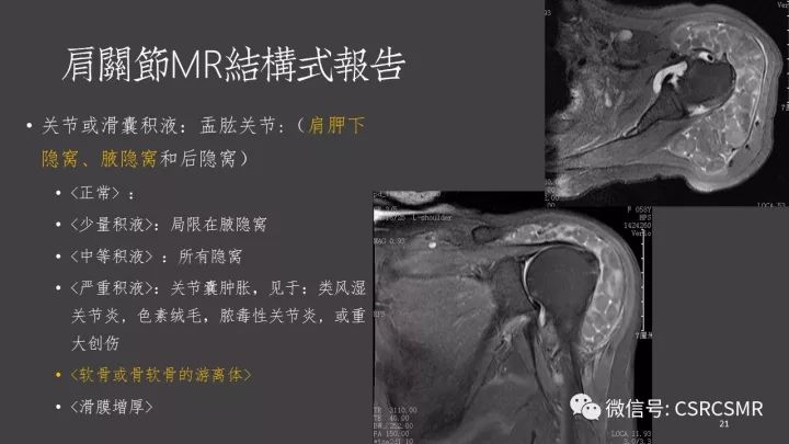 影像PPT - 【PPT】肩关节MRI的结构式评估-21