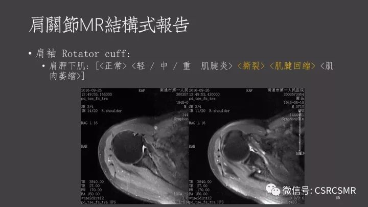 影像PPT - 【PPT】肩关节MRI的结构式评估-35