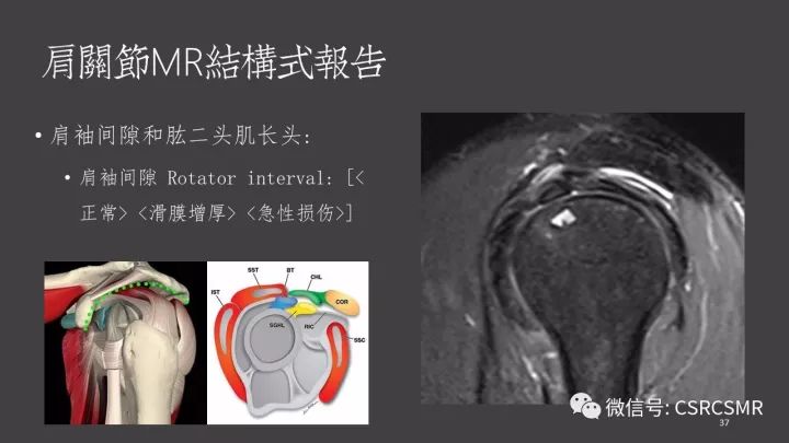 影像PPT - 【PPT】肩关节MRI的结构式评估-37