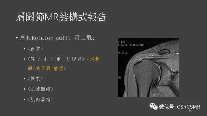 影像PPT - 【PPT】肩关节MRI的结构式评估-31