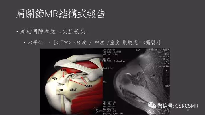 影像PPT - 【PPT】肩关节MRI的结构式评估-39