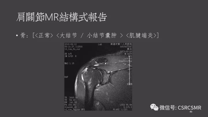 影像PPT - 【PPT】肩关节MRI的结构式评估-46