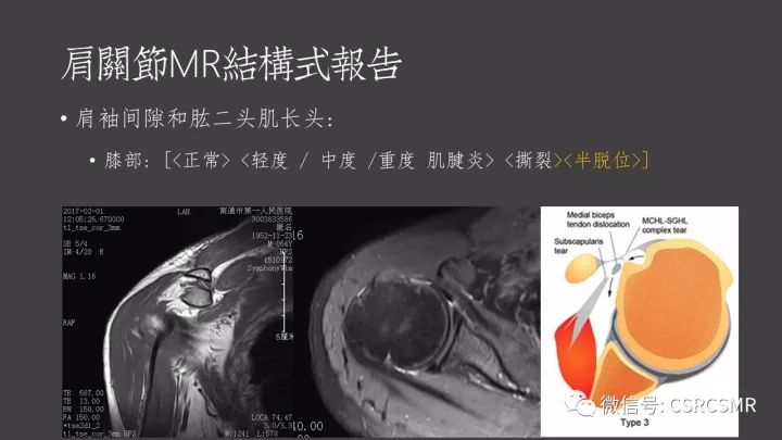 影像PPT - 【PPT】肩关节MRI的结构式评估-41