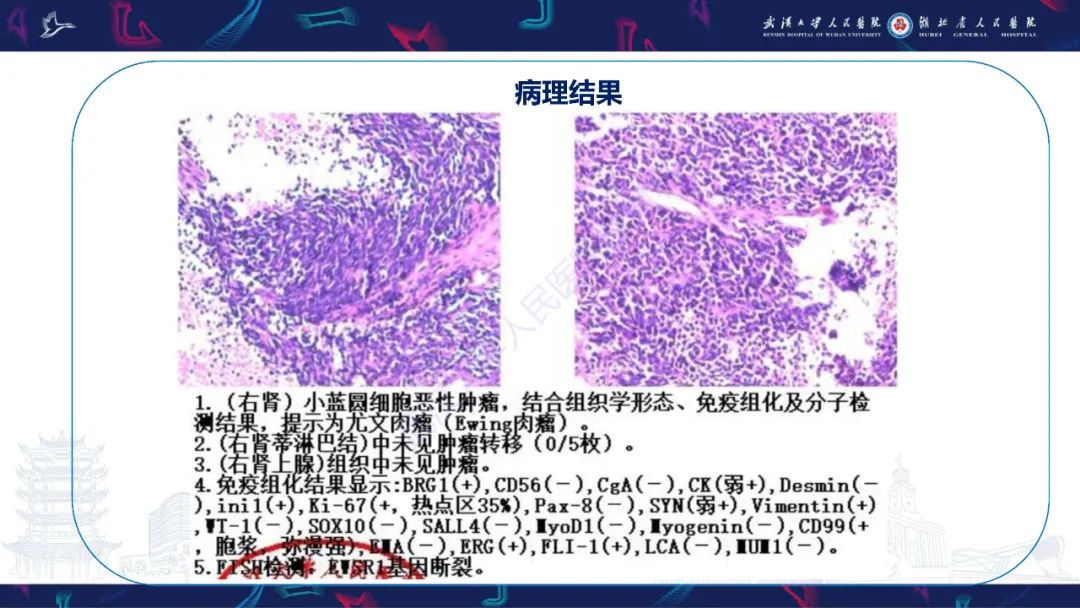 影像PPT - 【PPT】肾脏原发性尤文肉瘤影像诊断-7