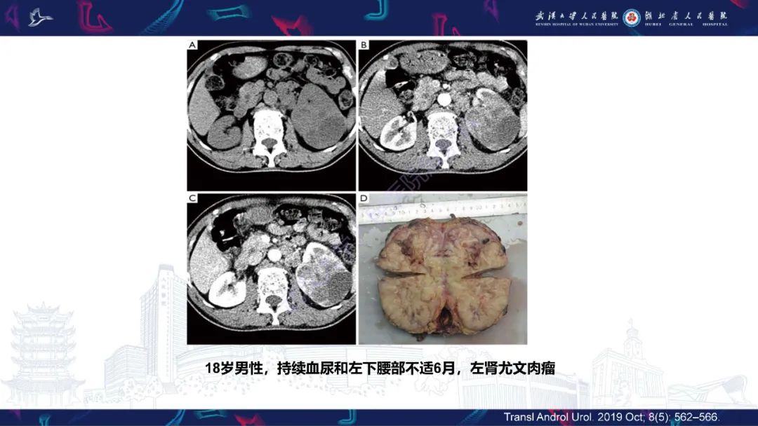 影像PPT - 【PPT】肾脏原发性尤文肉瘤影像诊断-15