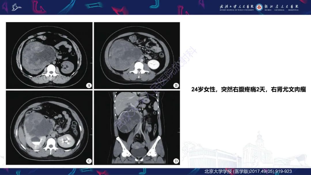 影像PPT - 【PPT】肾脏原发性尤文肉瘤影像诊断-16