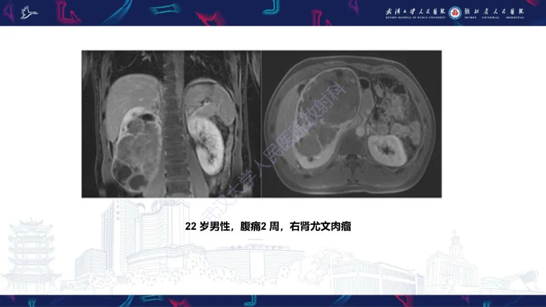 影像PPT - 【PPT】肾脏原发性尤文肉瘤影像诊断-18