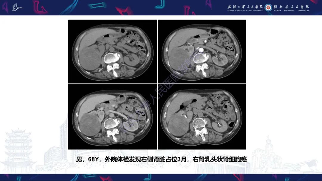 影像PPT - 【PPT】肾脏原发性尤文肉瘤影像诊断-21