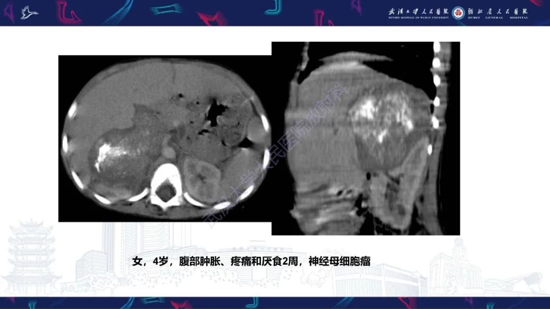 影像PPT - 【PPT】肾脏原发性尤文肉瘤影像诊断-25