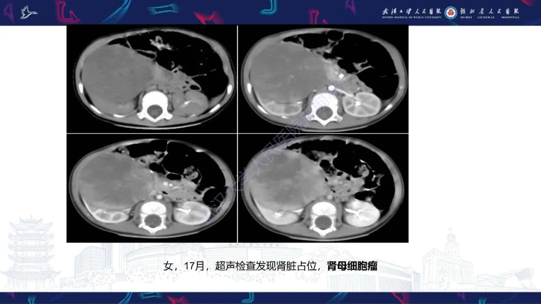影像PPT - 【PPT】肾脏原发性尤文肉瘤影像诊断-23