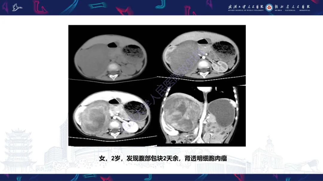 影像PPT - 【PPT】肾脏原发性尤文肉瘤影像诊断-27