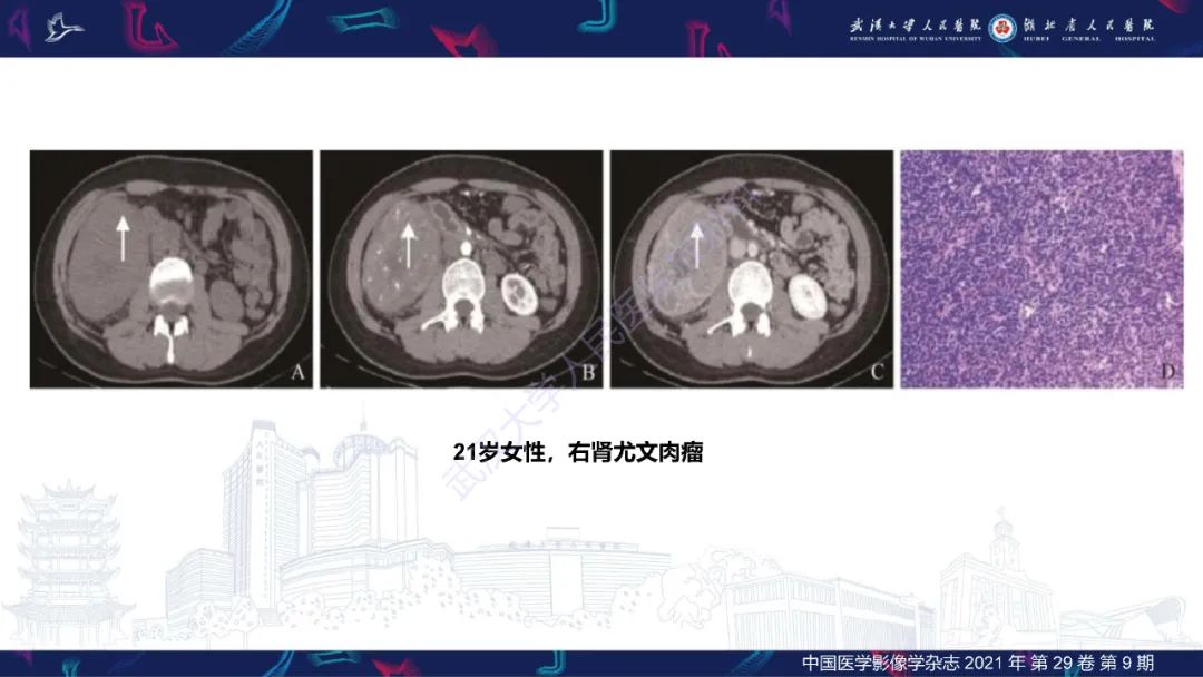 影像PPT - 【PPT】肾脏原发性尤文肉瘤影像诊断-17