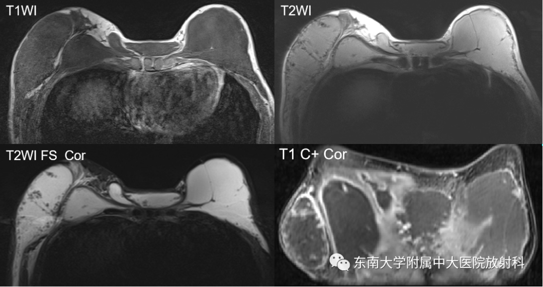 影像PPT - 【PPT】隆乳术后假体破裂的MRI表现-1