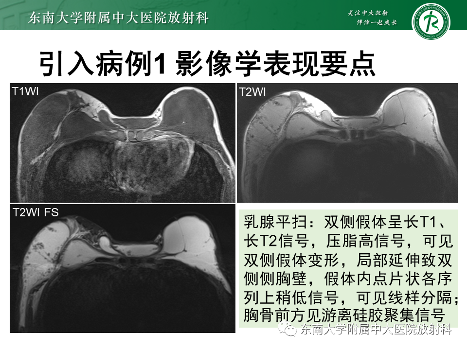 影像PPT - 【PPT】隆乳术后假体破裂的MRI表现-6