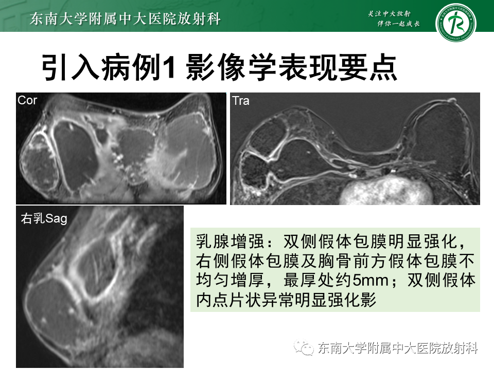影像PPT - 【PPT】隆乳术后假体破裂的MRI表现-7