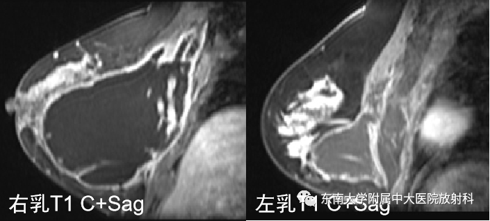 影像PPT - 【PPT】隆乳术后假体破裂的MRI表现-5