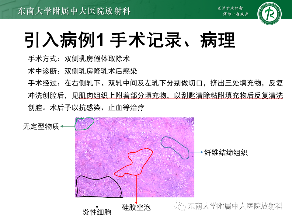 影像PPT - 【PPT】隆乳术后假体破裂的MRI表现-8