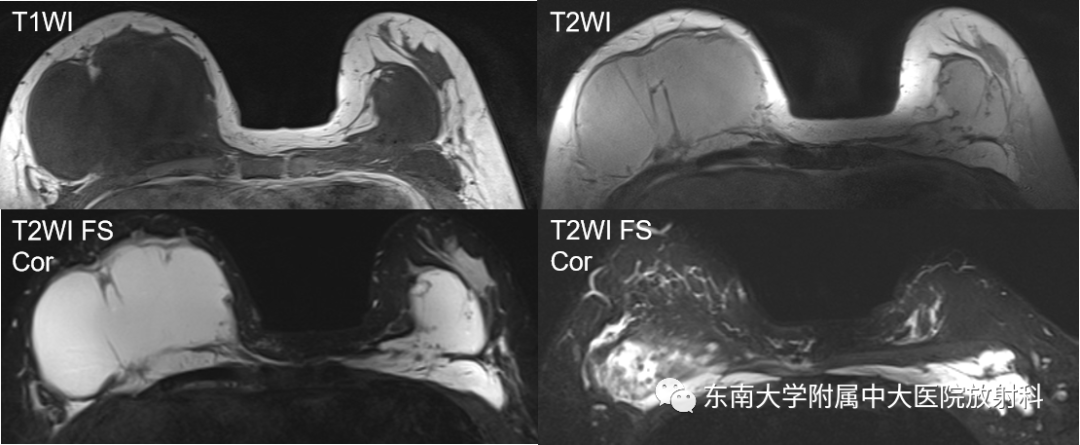 影像PPT - 【PPT】隆乳术后假体破裂的MRI表现-3