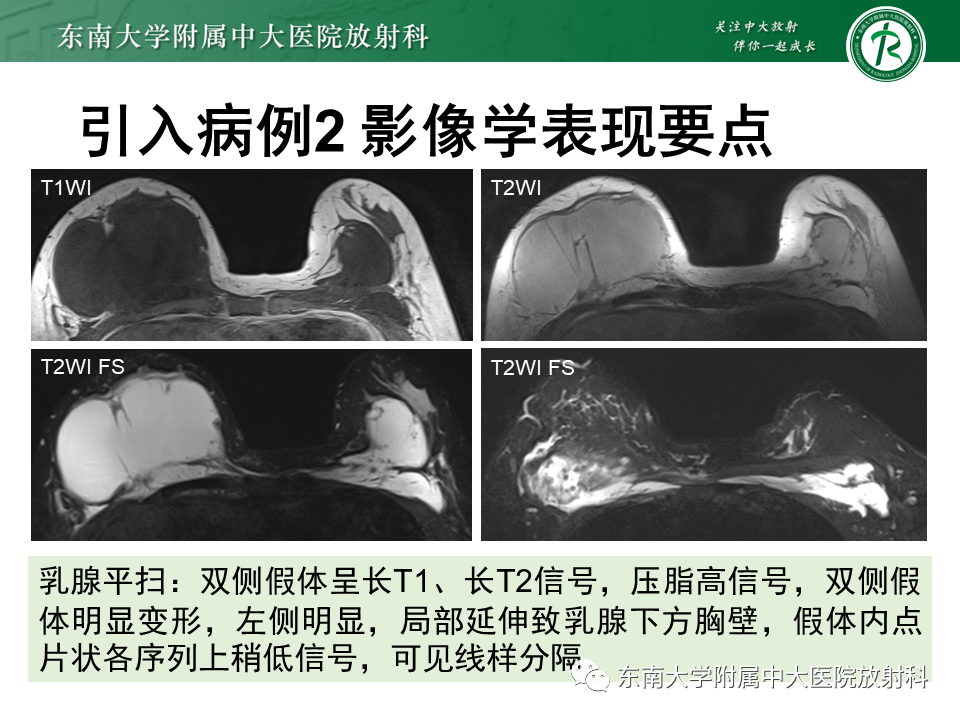 影像PPT - 【PPT】隆乳术后假体破裂的MRI表现-9